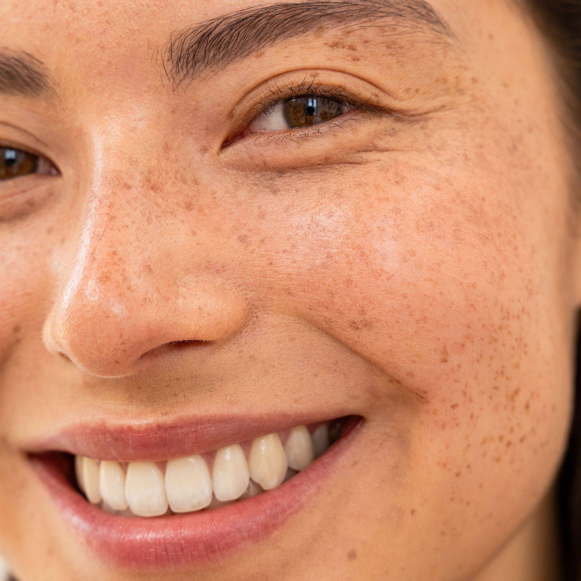 Close-up of a smiling person with freckles and clear skin, highlighting a visible eye, nose, and teeth.